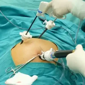 LAPAROSCOPIA  (05/nov/2025)